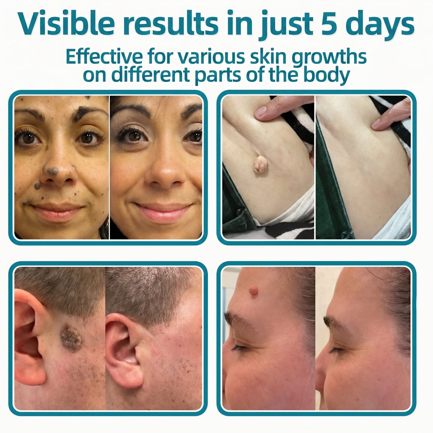 ✅🇦🇺Baelorax®2-in-1 Microneedle & Hydrocolloid Patch💫| Removes Raised Moles, Acne, Flat Warts & Skin Tags | Helps Improve Wrinkles, Scars & Blemishes | Invisible Patches for Face & Body