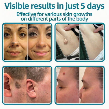✅🇦🇺Baelorax®2-in-1 Microneedle & Hydrocolloid Patch💫| Removes Raised Moles, Acne, Flat Warts & Skin Tags | Helps Improve Wrinkles, Scars & Blemishes | Invisible Patches for Face & Body