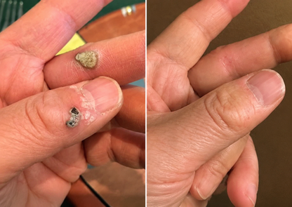 ✅🇦🇺Baelorax®2-in-1 Microneedle & Hydrocolloid Patch💫| Removes Raised Moles, Acne, Flat Warts & Skin Tags | Helps Improve Wrinkles, Scars & Blemishes | Invisible Patches for Face & Body