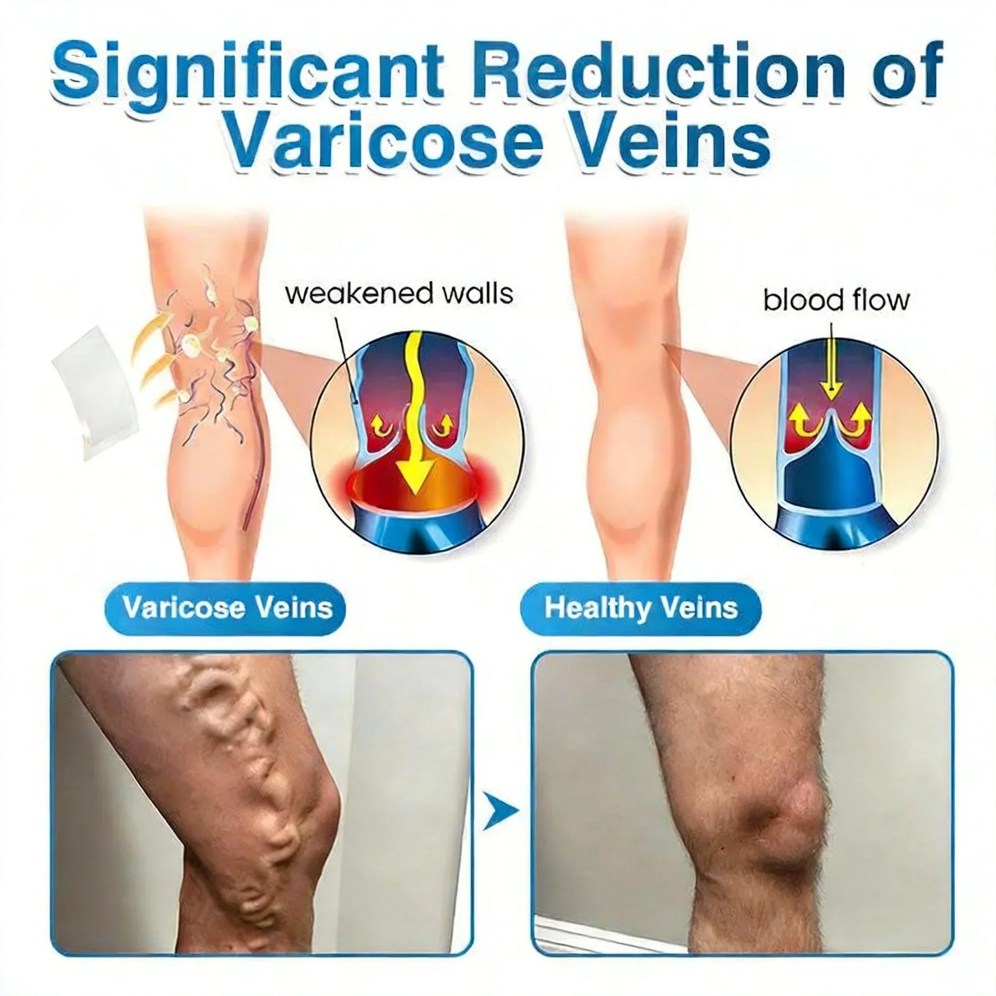 Microneedle Vein Repair Patch for Fast Spider Vein Relief
